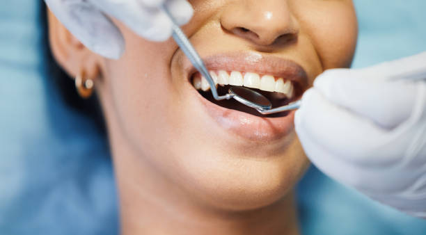 Best Emergency Wisdom Teeth Removal in Ames, IA