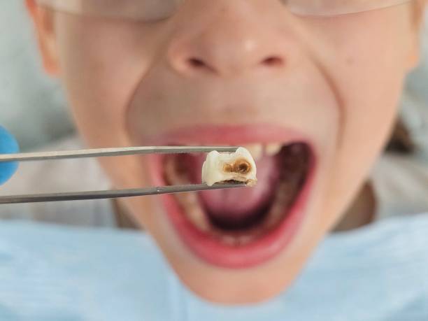 Best Emergency Tooth Extraction in Ames, IA